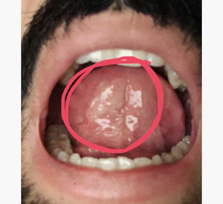 Mein Partner hat eine Entzündung unter der Zunge was ist das